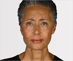 Pamela before her Botox treatment