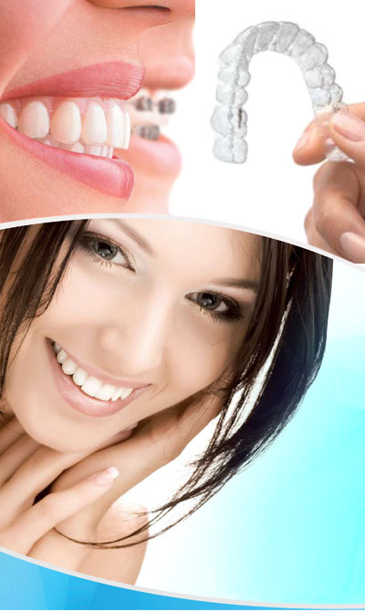Invisalign braces