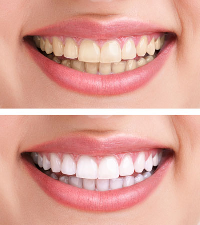 Teeth whitening in Doncaster